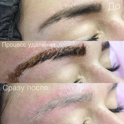 Инновационный метод удаления тату: скачайте фото в webp формате
