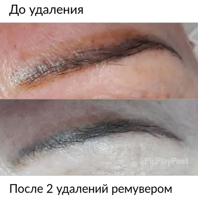 Отличные результаты удаления тату: фото до и после