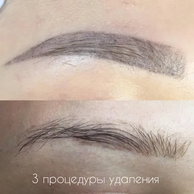 Улучшение вашей кожи: удаление тату на фото