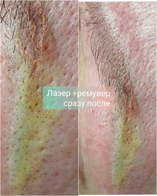 Удаление тату ремувером: выберите фотографию для удаления
