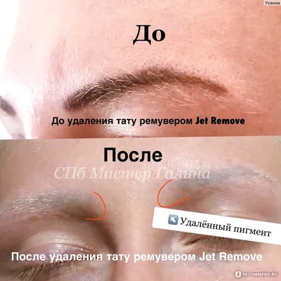 Удаление тату с помощью ремувера: скачайте качественное изображение в webp формате