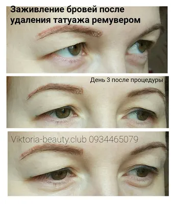 [39+] Удаление тату ремувером фото