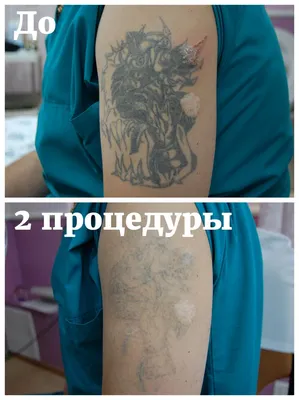 Фотка Удаление тату: изображение в разных форматах и с разными размерами