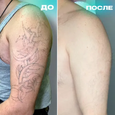 Фото Удаление тату: выбор размера и формата изображения