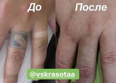 Удаление тату: фото в разных форматах и размерах