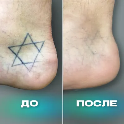 Картинка Удаление тату: выбор формата и размера для загрузки