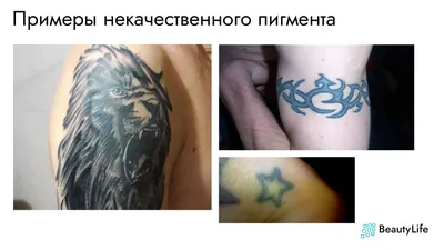 Фото Удаление тату: выбор размера и формата изображения