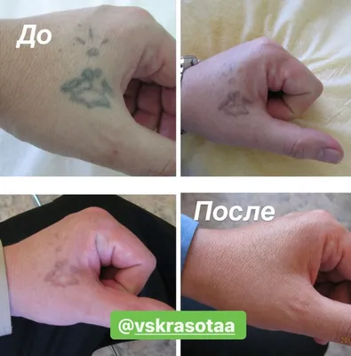 Изображение Удаление тату: выберите желаемый размер и формат скачивания