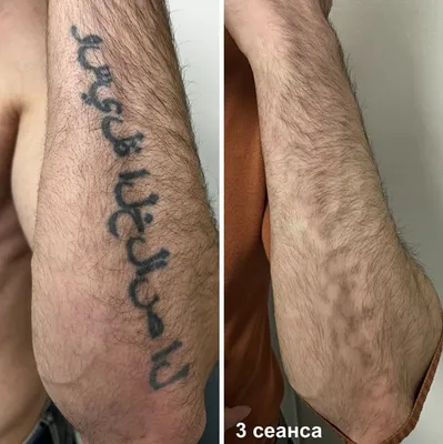 Фотка Удаление тату: изображение в разных размерах и форматах
