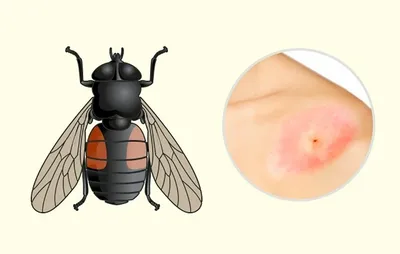 Фото укуса комара аллергии - скачать в формате JPG