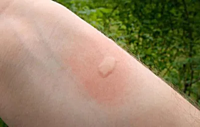 Фото укуса комара аллергии в формате WebP