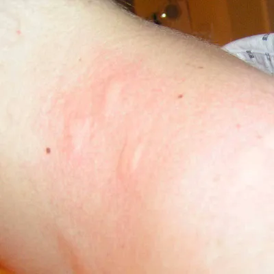 Укус комара: фото аллергической реакции и особенности у взрослых