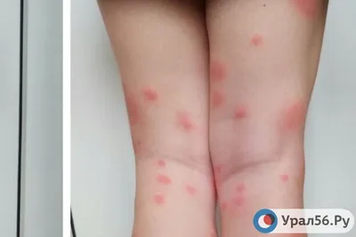 Новое изображение укуса комара ребенка в 4K