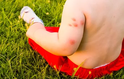 Фото укуса комара ребенка в формате JPG, PNG, WebP для скачивания