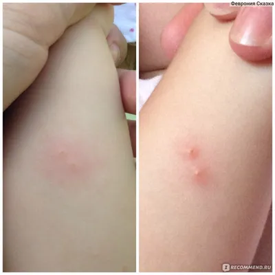 Фото укуса комара ребенка: скачать бесплатно в разных размерах