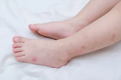 Укус комара ребенка: фото и симптомы