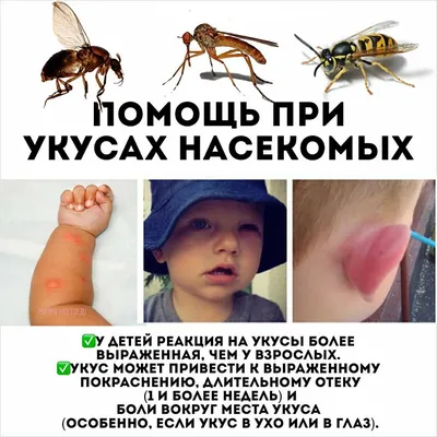 Укус комара ребенка: фото в Full HD