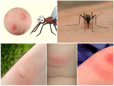 Фото укуса комара ребенка в разных размерах