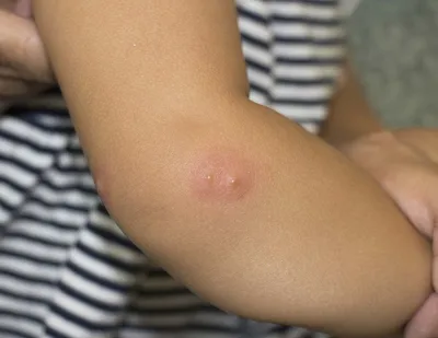 Укус комара ребенка: фото и симптомы инфекции