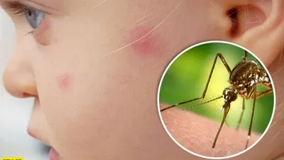 Фото укуса комара ребенка: как ухаживать за укусом
