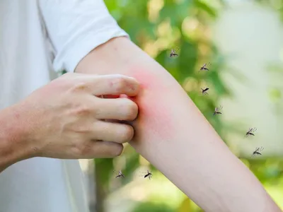 Укусы комаров и мошек у детей: фотографии и сведения