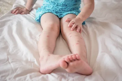 4K фото укусов комаров у детей до года