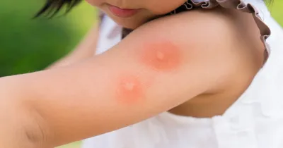 Укусы комаров у младенцев  фото