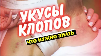 Фото укусов комаров у младенцев для скачивания