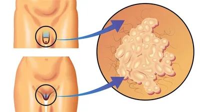 Фотографии: симптомы вируса папилломы человека у мужчин в формате WebP