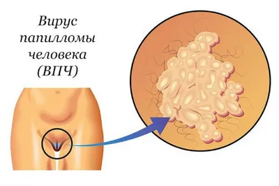 Фотография человека с вирусом папилломы: выбор изображения (PNG, JPG, WebP)