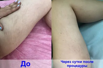 Виски пеленание до и после - Картинка в формате JPG