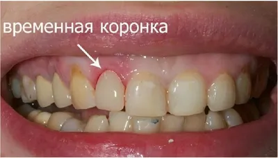 Фото Временный зуб бабочка для использования на сайте (JPG)