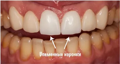 Изображение Временный зуб бабочка для скачивания в PNG формате с эффектом глубины