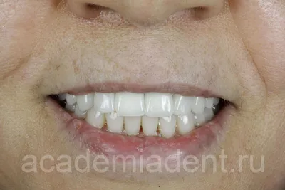 Фотка Временный зуб бабочка в WebP формате с возможностью добавления эффекта Минимализм