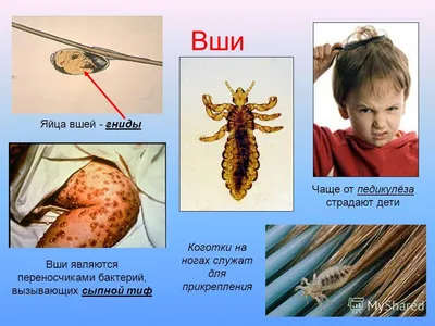 Фото вши: Изображение человека по вашему