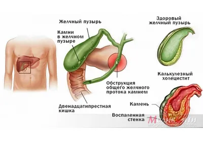 Картинка Желчного Пузыря: Выберите Подходящий Размер и Формат