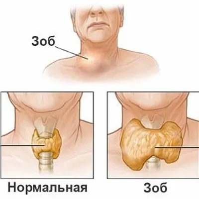 Эксклюзивные фотографии зоба с разными эффектами