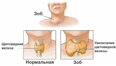 Фотогалерея: Зоб человека в разных цветовых оттенках